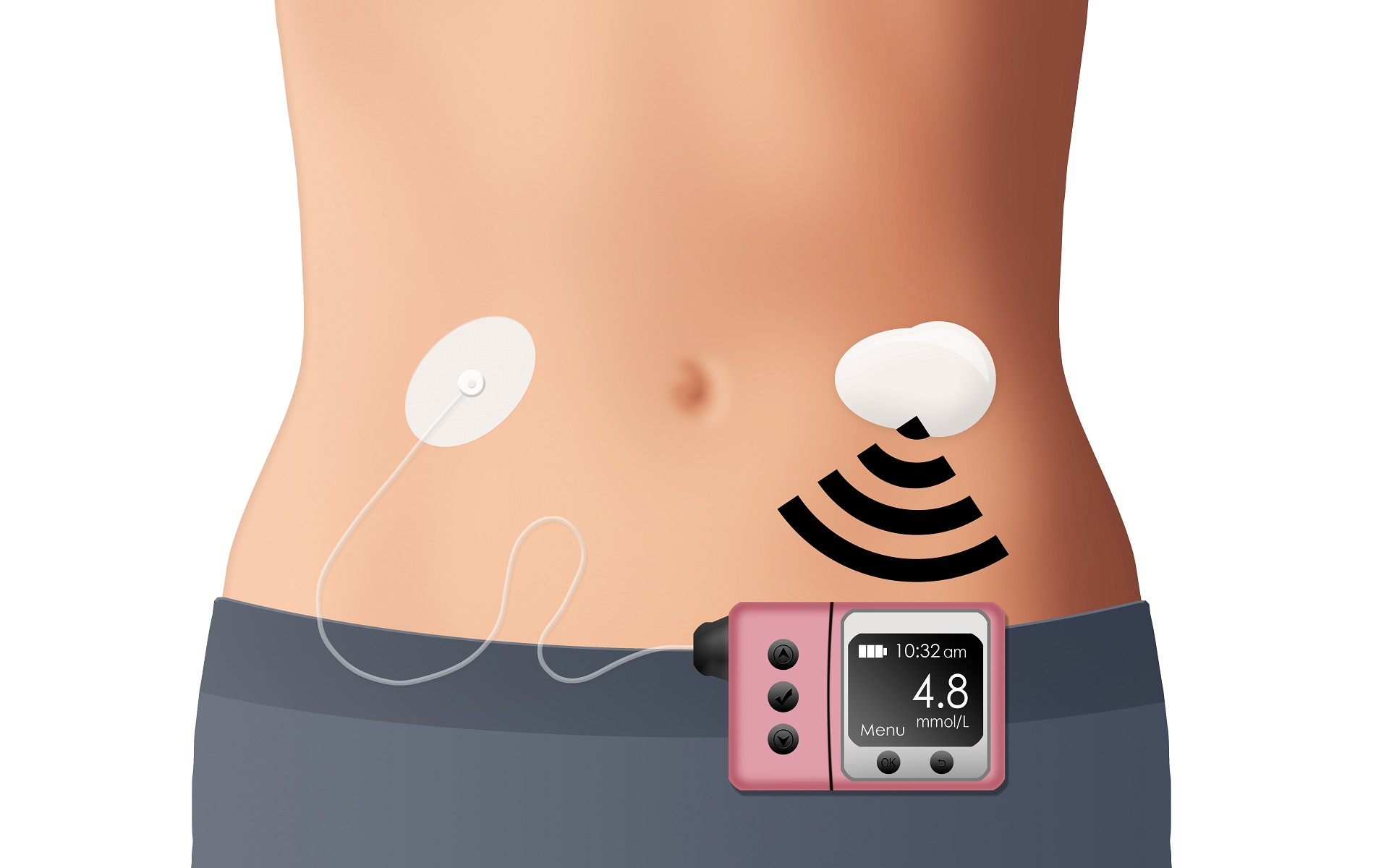 Insulinpumpen und AIDSysteme für die DiabetesTherapie DiabetesAnker