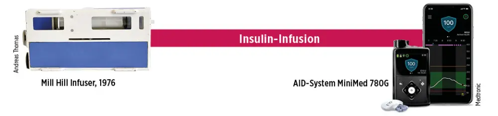 Darstellung der Entwicklung im Bereich Insulin-Infusion: Rechts ist der Mill Hill Infuser aus dem Jahr 1976 abgebildet, rechts das AID-System MiniMed 780G von Medtronic.