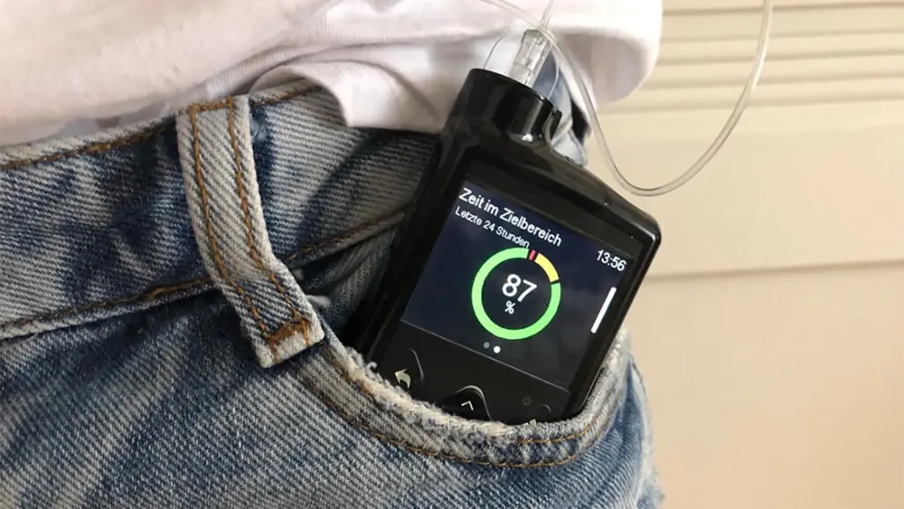 Erfahrungsbericht: MiniMed 780G und dem Guardian 4 Sensor nach vier Monaten | Foto: Sara Brandt