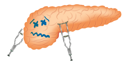 Pankreas mit traurigem Gesicht und zwei Krücken 
