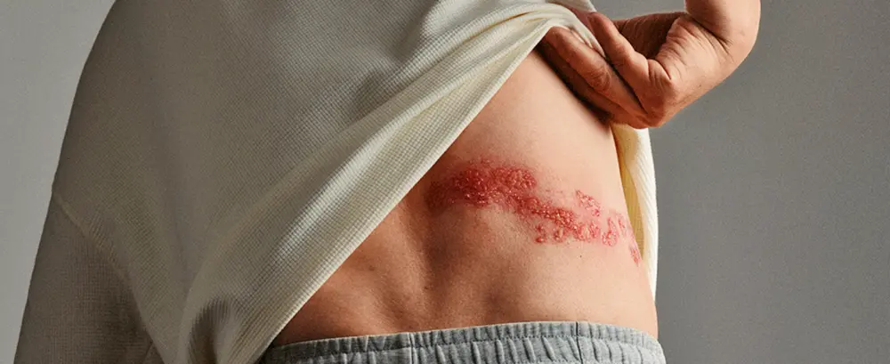 Jeder Dritte erkrankt an Gürtelrose: Vorsorge für Ältere und chronisch Kranke besonders wichtig | Foto: Publicis China / Publicis UK – ASSET-242627