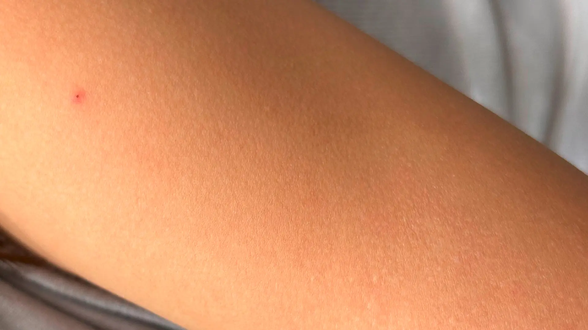 Abb. 1: Gesunde Haut am Oberarm. | Foto: UKSH