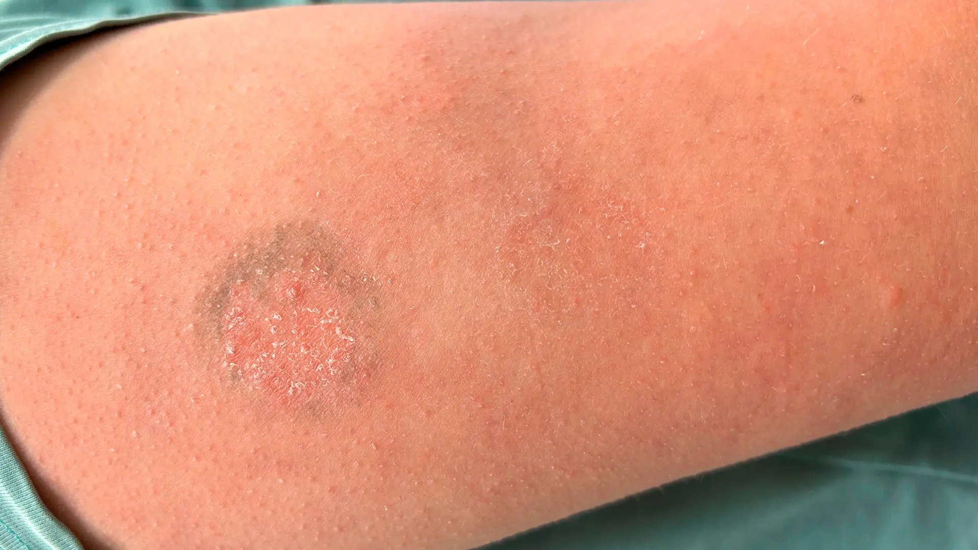 Abb. 2: Reibeisenhaut am Oberarm. | Foto: UKSH