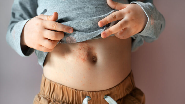 „HAUT-Sache Typ-1-Diabetes“ – Teil 3: Was tun, wenn Haut-Veränderungen auftreten? | Foto: shangarey – stock.adobe.com