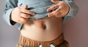 „HAUT-Sache Typ-1-Diabetes“ – Teil 3: Was tun, wenn Haut-Veränderungen auftreten? | Foto: shangarey – stock.adobe.com